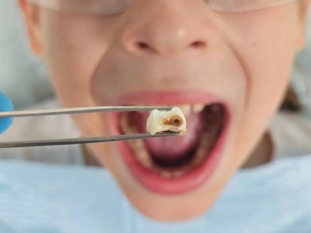 Best Emergency Dentist for Lost Fillings or Crowns in La Mirada, CA